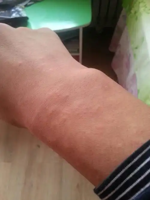 12:35陶威宇医师 回答: 病情分析: 你好,可能是毛囊炎引起的,其