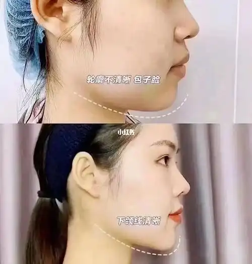 下颚线  #少女感  #拯救下颚线  #下颌线
