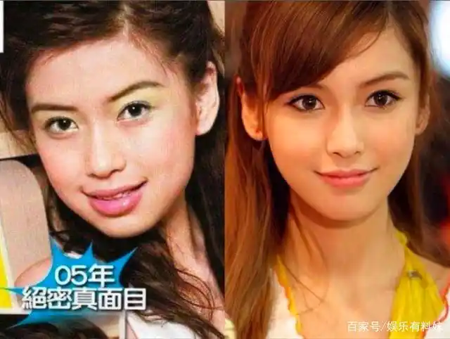 对比刚出道时期,baby的颧骨高度也有了很大改善,这个填苹果肌就能解决