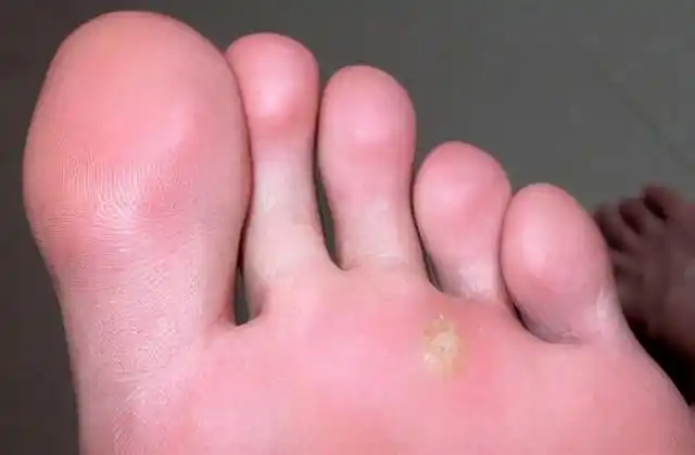 点状掌跖角化症与寻常疣