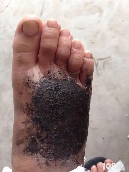 厨房高压锅爆炸港城女子脚背血肉模糊 用它炖汤要小心!