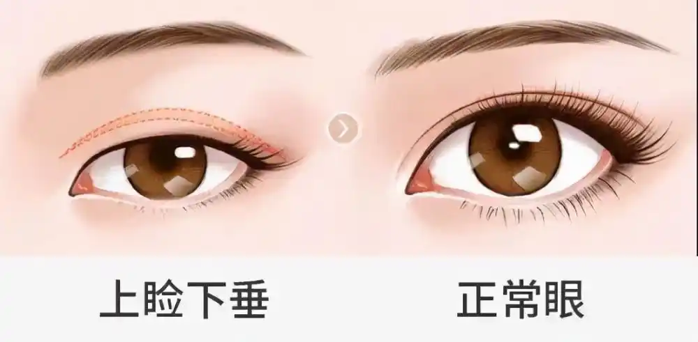 垂得太多,可就是上睑下垂,得治啊可是,这上眼皮垂