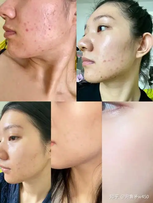 有什么好用的去痘印产品推荐