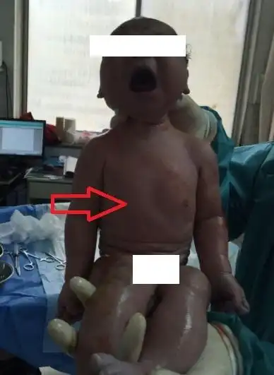 从两个宝宝的图片上看,胸口都有凹陷,但并不是非常严重.