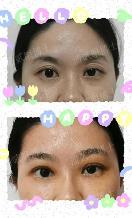 天生原因:因眼窝凹陷导致的多眼皮可直接通过脂肪填充来改善;2,修复