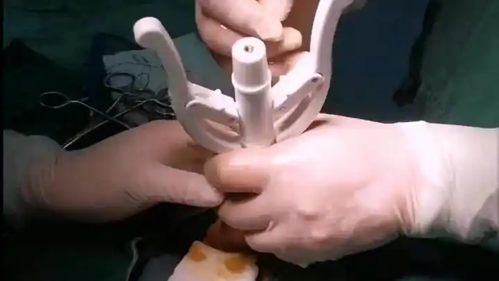 手术演示吻合器包皮环切术优点①手术时间短,安全无痛苦:手术时间仅需