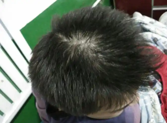 今年21岁,男 最近感觉到头顶头发变得稀疏,家人并无脱发现象,应该如