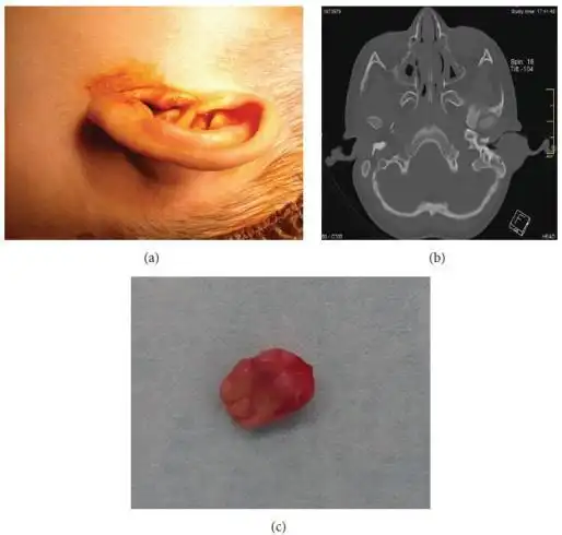 2岁男孩,6天前耳部出现一肿块,服用阿莫西林—克拉维酸治疗三天后未