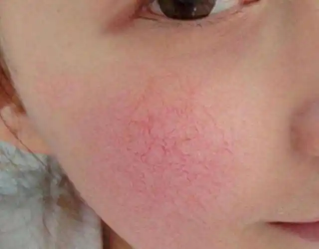 脸上有红血丝,是毛细血管扩张的结果,用它很快就能修复!