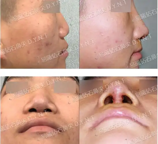 易曦院长binder综合征的诊断与治疗