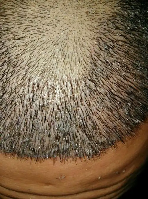 第八天头皮上全是血痂,还不好清理