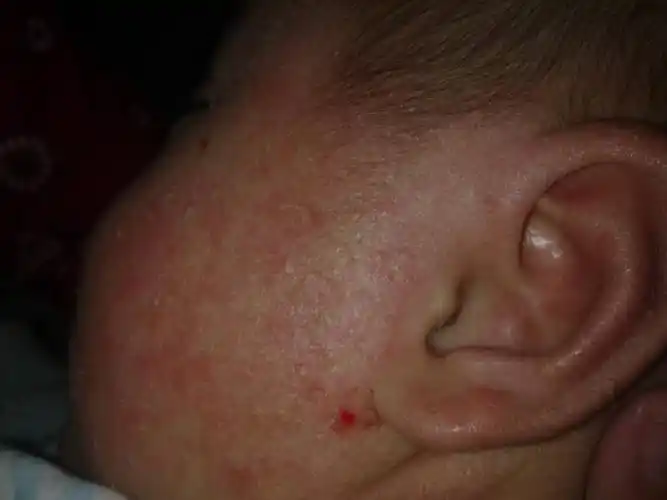 宝宝差4天4个月,现在脸上都是类似湿疹样的红红的一片(三四天一个周期