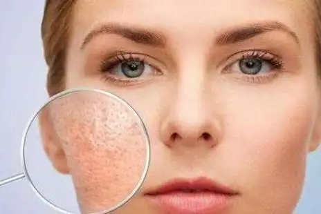 脸上起干皮,这个是最明显的一个情况,只有脸部严重缺水的时候皮肤才会