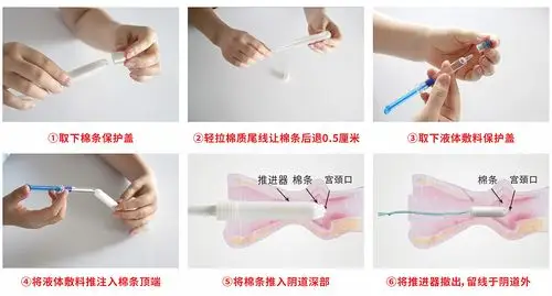 宫腔填塞吸附栓,阴道填塞吸附栓,阴道填塞止血吸附栓