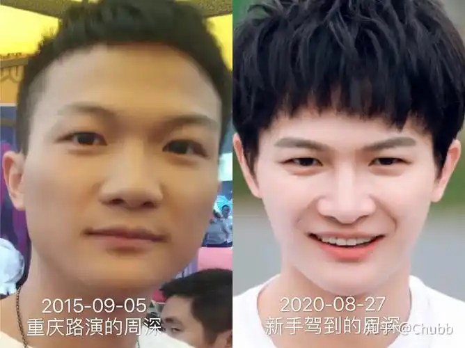 周深的鼻子形态分析(1)——玻尿酸填充时期 - 知乎