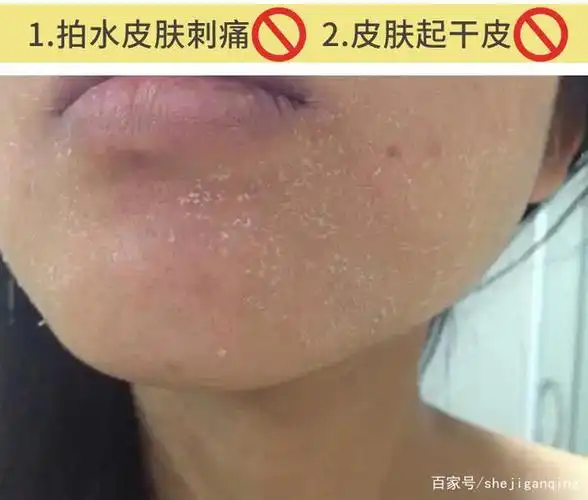 春季脸部皮肤太干燥了严重缺水怎么办用什么补水最快最有效?(精)