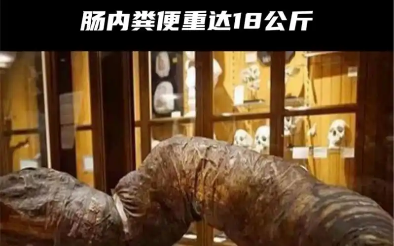 史上第一个被"屎"憋死的人,三年没上过厕所,肠内的粪便重达18公斤.