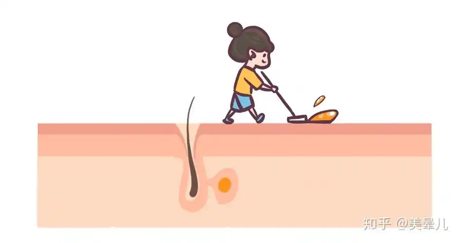 这是角质型毛孔粗大吗