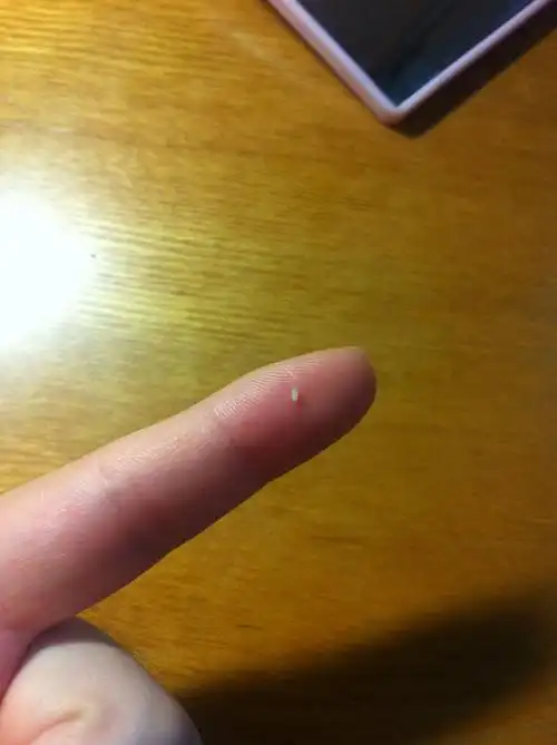 采纳数:17获赞数:37lv4 擅长:医疗健康  展开全部 脂肪粒