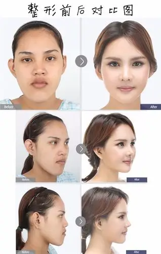 整形前后照片对比