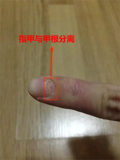 是灰指甲的症状吗? 该如何治疗? - 知乎