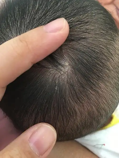婴儿头皮起皮