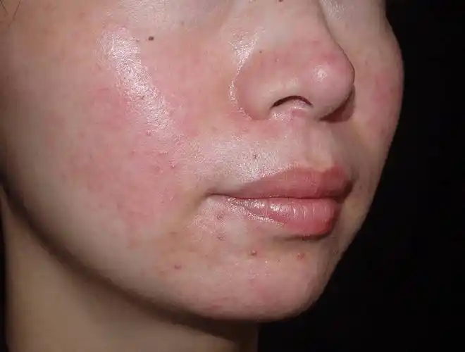 皮肤表层的修复屏障坏了怎么办一,皮肤屏障受损的原因1.