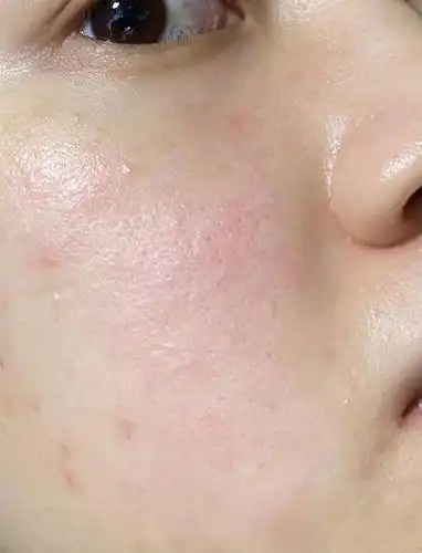 朋友们 请问这样是皮肤屏障受损了吗