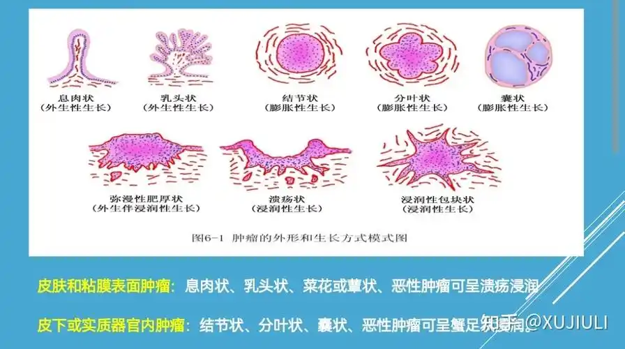 【肿瘤形成:肿瘤的增殖与机体不协调,克隆性的肿瘤细胞的形态,代谢