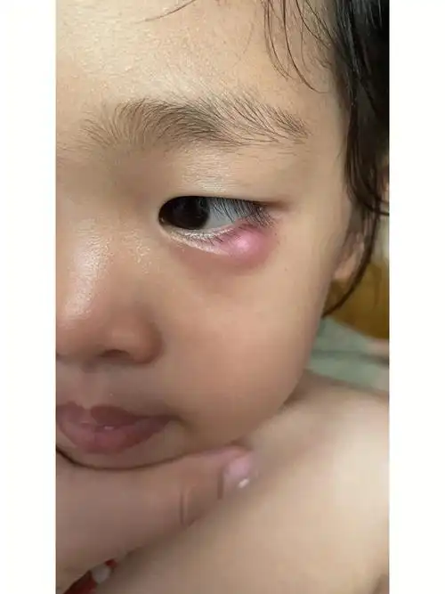 儿童睑板腺囊肿手术