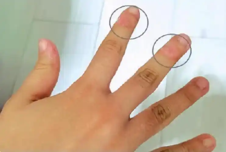 原创警惕!12岁女孩爱啃手指至变形,孩子到了这年龄还吃手容易毁颜值