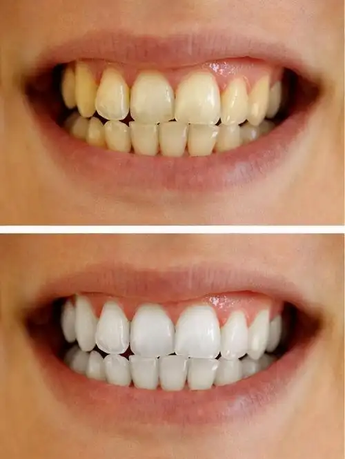 现代人对口腔卫生很重视,一天刷两次牙很正常,那为什么牙齿还是会变黄