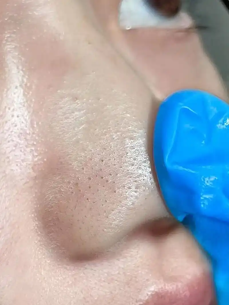 这个去黑头的千万别停产……给我火!鼻子有黑头的姐妹都去用 - 抖音