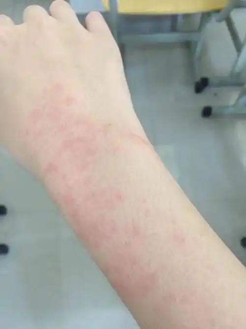 日光性皮炎你了解吗?_患者_症状_皮肤