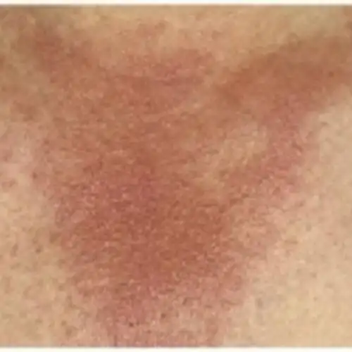 多形性日光疹处理方法:可以外用一些止痒抗过敏的药物,注意不要忘记