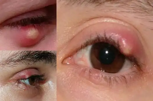 图片麦粒肿图片麦粒肿俗称针眼,是一种眼睑腺体的急性,痛性,化脓性