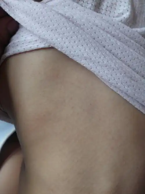 宝宝这是鸡蛋过敏吗?刚吃了