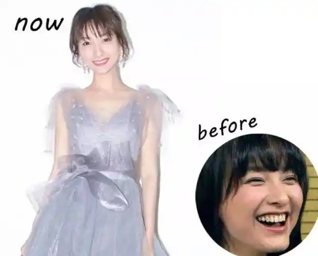 吴昕 牙齿美白前后当然,除了这三种等级的医疗美白,日常对牙齿的护理