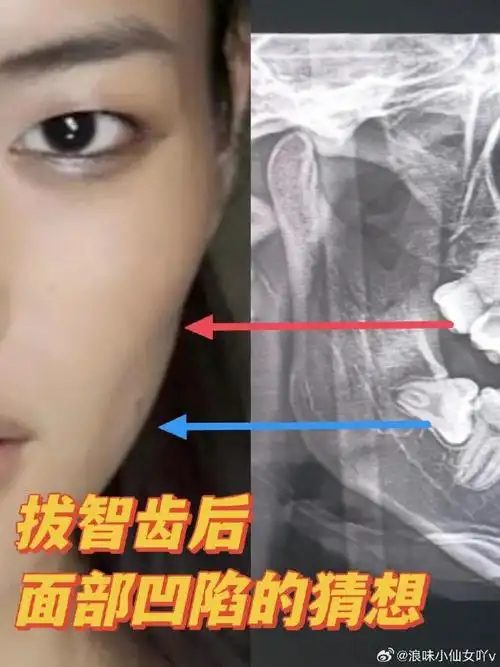 拔完智齿会面部凹陷吗