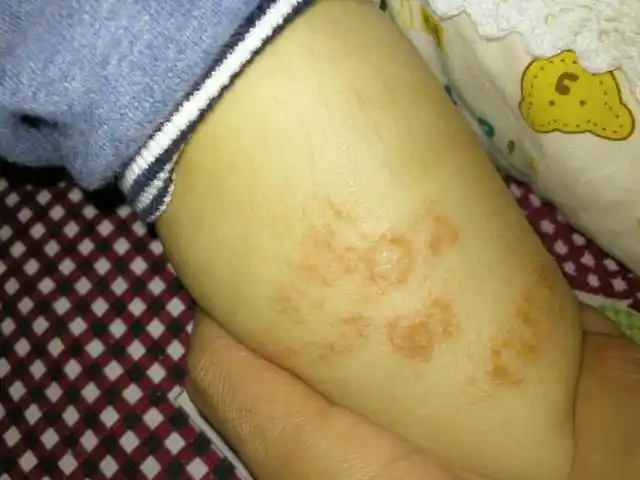 我家宝宝的小腿上有很多像湿疹样的症状,很痒,已经抓破了,请大家看看