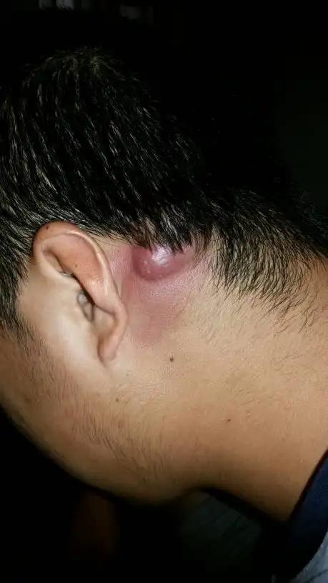 张个软包几个月后破了去医院看看医生说不是脂肪瘤是毛囊啥的最近边