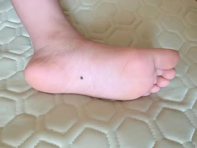 出生自带的脚底痣,终于切除了