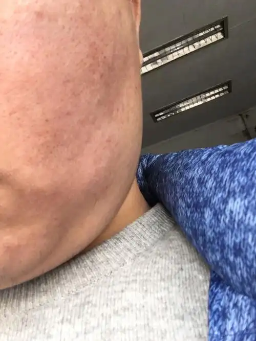 我是男生,脸上皮肤比较粗糙,毛孔比较粗,毛孔下还发红发黑,冬天很干.