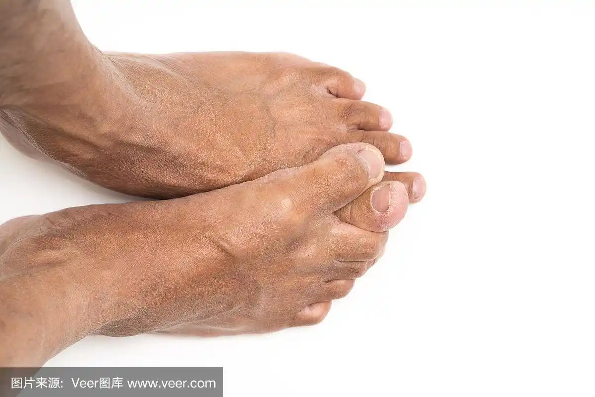 亚洲男人脚棕色和干燥的皮肤