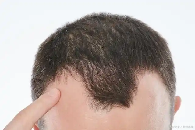 m型脱发是怎么一步步变成秃头的怎么改善
