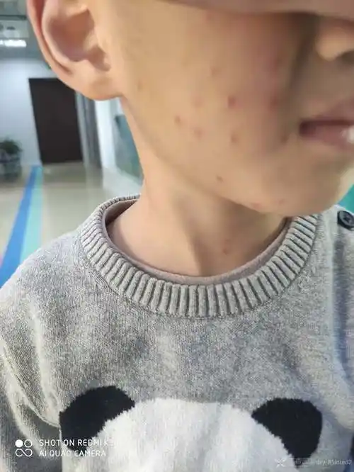 不是皮肤科医生但是经常有儿童皮肤病来看最近看了好几例相同的皮疹