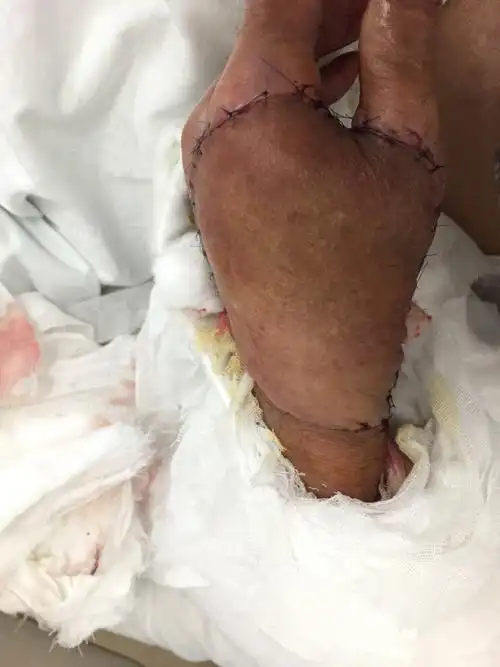 手背鳞癌就需要截肢吗?_皮肤癌_皮肤癌治疗方式 - 好大夫在线