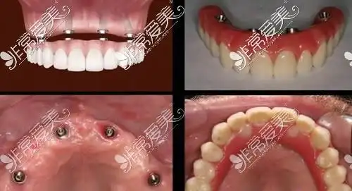 半口牙种植大约多少钱allon4一般需要几颗种植体