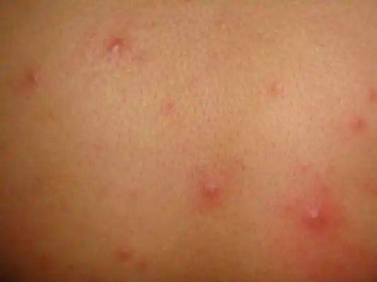艾滋初期皮疹图片40