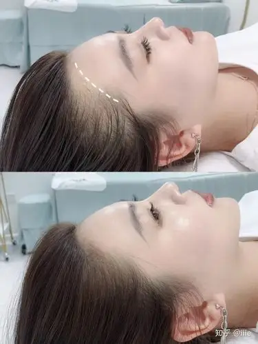 如图所示的m型发际线,需要调整两个额角的位置,同时需要做美人尖位置